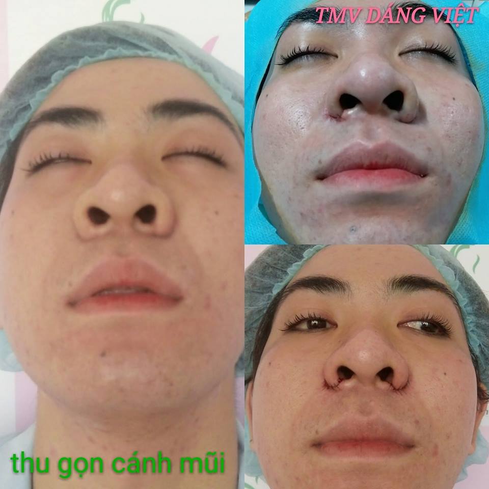 Thu gọn cánh mũi